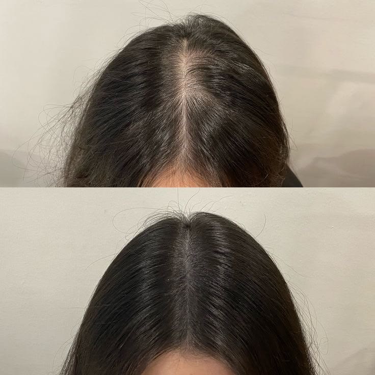 Before and after, hair restoration, crown and part
